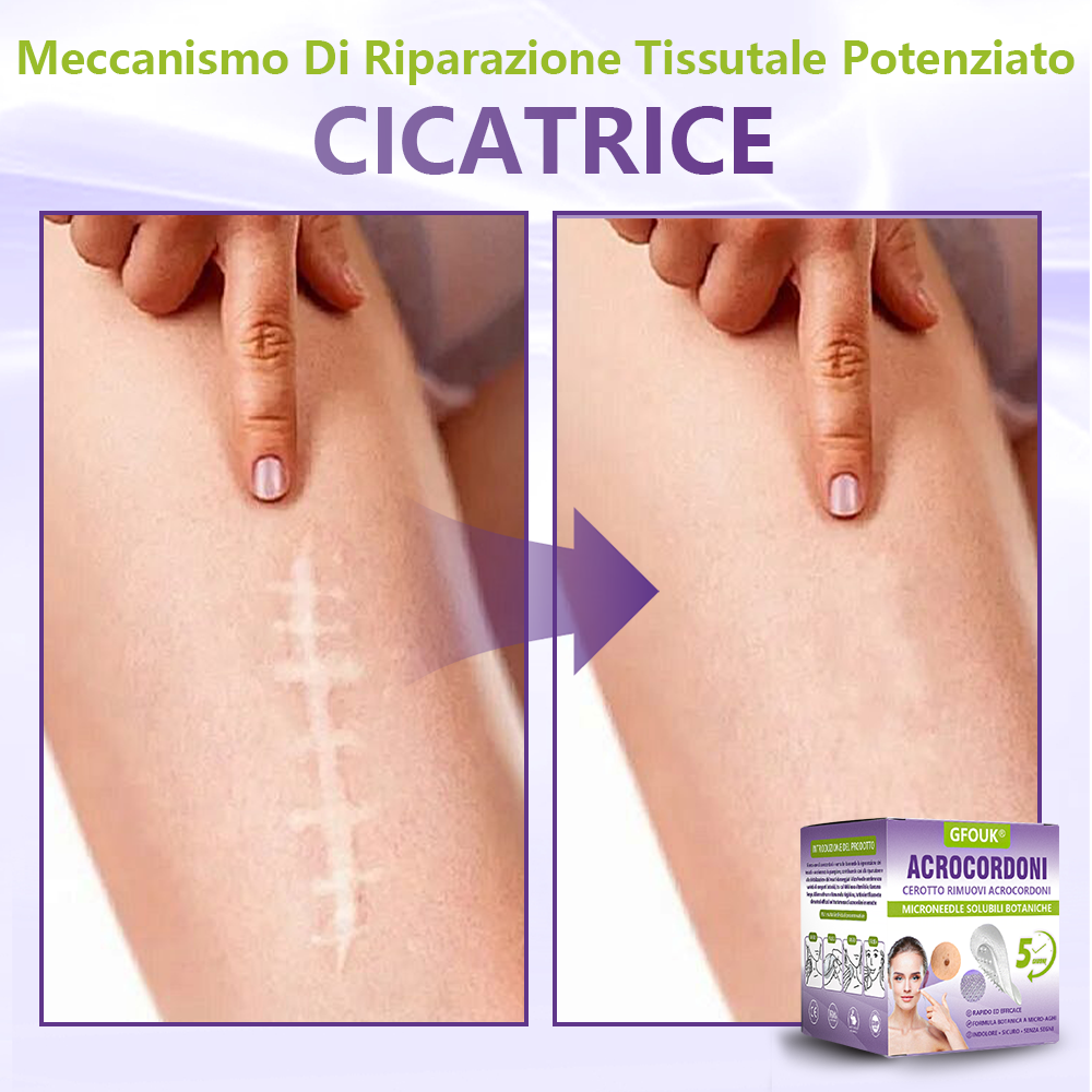GFOUK® Cerotto con microaghi dissolvibili a base vegetale per la rimozione dei fibromi penduli🌿