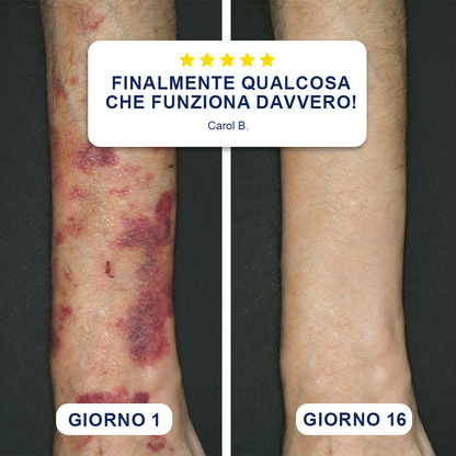 ✨Evolvion® Crema per Lividi e Rinforzo della Pelle 🌼