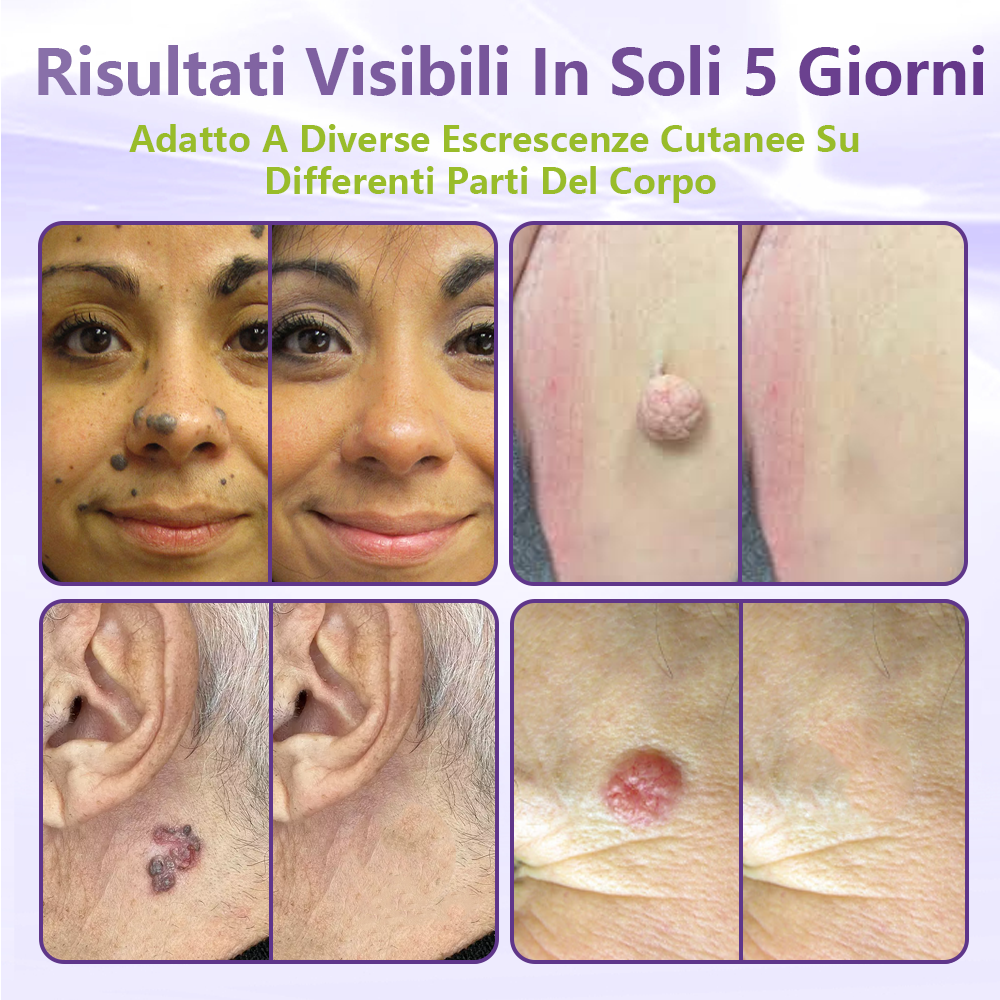 GFOUK® Cerotto con microaghi dissolvibili a base vegetale per la rimozione dei fibromi penduli🌿