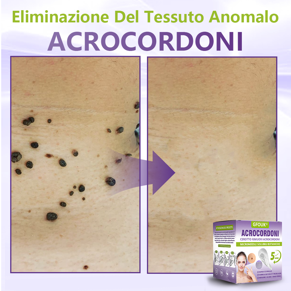 GFOUK® Cerotto con microaghi dissolvibili a base vegetale per la rimozione dei fibromi penduli🌿