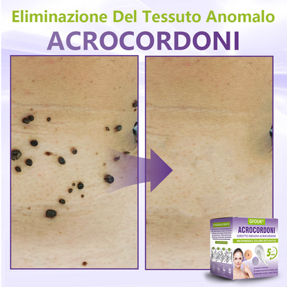 GFOUK® Cerotto con microaghi dissolvibili a base vegetale per la rimozione dei fibromi penduli🌿