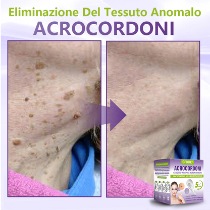 GFOUK® Cerotto con microaghi dissolvibili a base vegetale per la rimozione dei fibromi penduli🌿