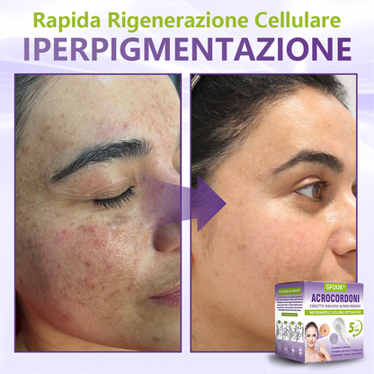 GFOUK® Cerotto con microaghi dissolvibili a base vegetale per la rimozione dei fibromi penduli🌿