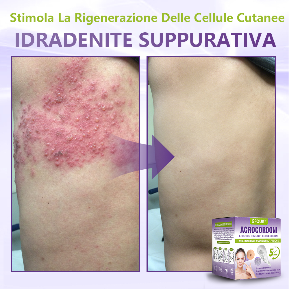 GFOUK® Cerotto con microaghi dissolvibili a base vegetale per la rimozione dei fibromi penduli🌿