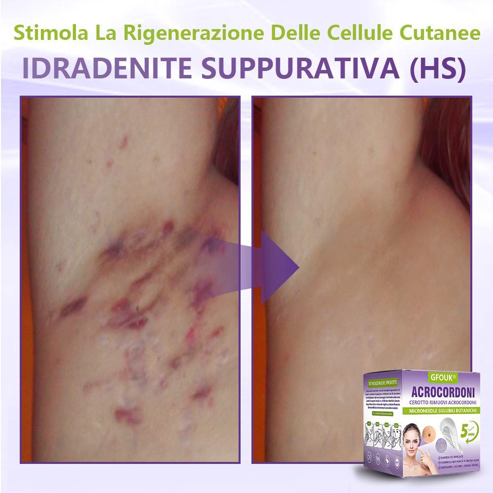GFOUK® Cerotto con microaghi dissolvibili a base vegetale per la rimozione dei fibromi penduli🌿