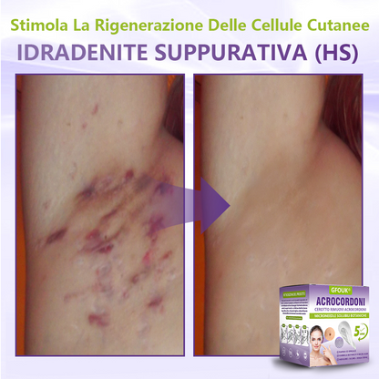 GFOUK® Cerotto con microaghi dissolvibili a base vegetale per la rimozione dei fibromi penduli🌿